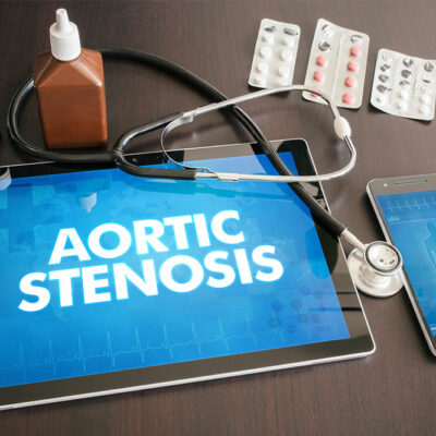 Aortic stenosis- Symptoms, diagnosis, and management