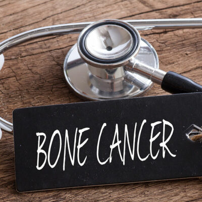 7 early signs of bone cancer